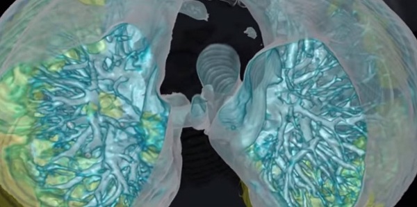 Video en 3D detalla cómo el coronavirus daña los pulmones