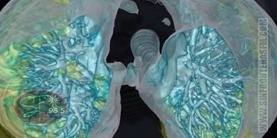 Video en 3D detalla cómo el coronavirus daña los pulmones