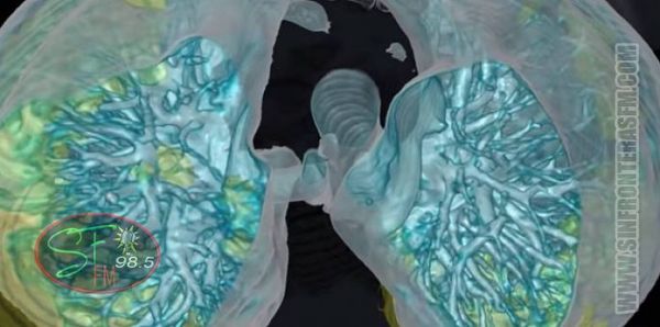 Video en 3D detalla cómo el coronavirus daña los pulmones