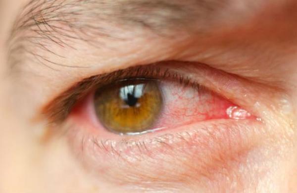 El primer síntoma del coronavirus puede ser una conjuntivitis - SNT