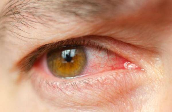 El primer síntoma del coronavirus puede ser una conjuntivitis - C9N