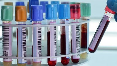 Hemofilia: Vivir con dificultades en la coagulación de la sangre » Ñanduti