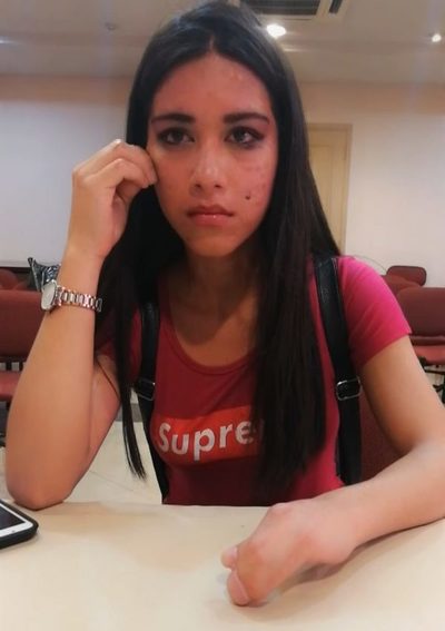 "Tenia miedo de ser rechazada por el defecto en mi mano" - Paraguay Informa