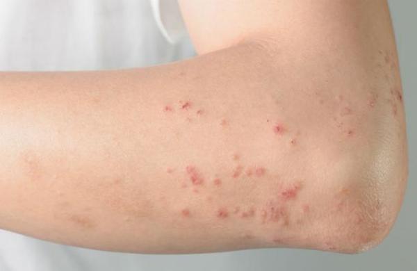 Las cinco manifestaciones que tiene en la piel el coronavirus - C9N