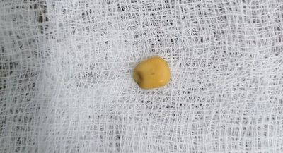 Grano de maíz obstruía vía respiratoria de un niño de 2 años