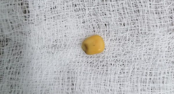 Grano de maíz obstruía vía respiratoria de un niño de 2 años