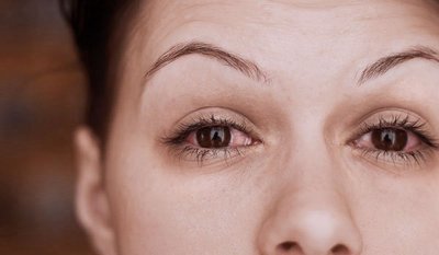 Conjuntivitis puede indicar la presencia del virus SARS-CoV-2 (COVID 19) según estudio científico » Ñanduti