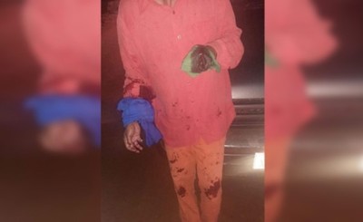 Queman un biciclo y cortan la mano a su dueño con un machetillo