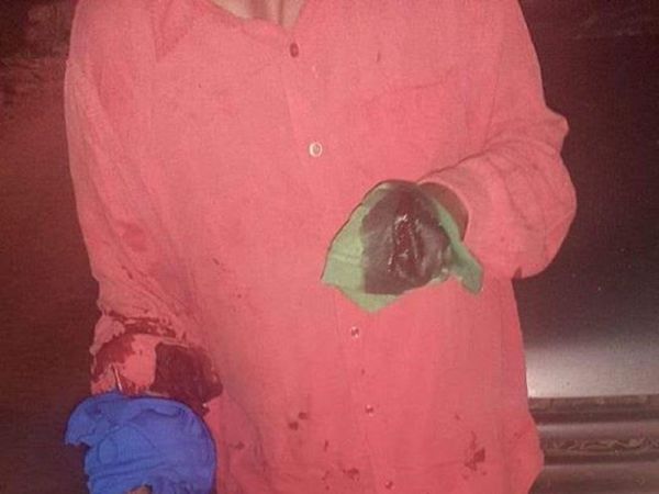 De un machetazo le amputaron la mano