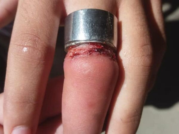 Bomberos le salvaron el dedo a un niño