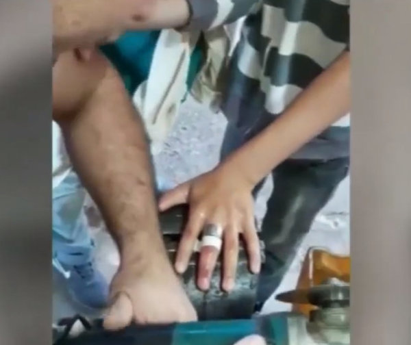 Usaron amoladora para retirar anillo atorado en el dedo de un niño