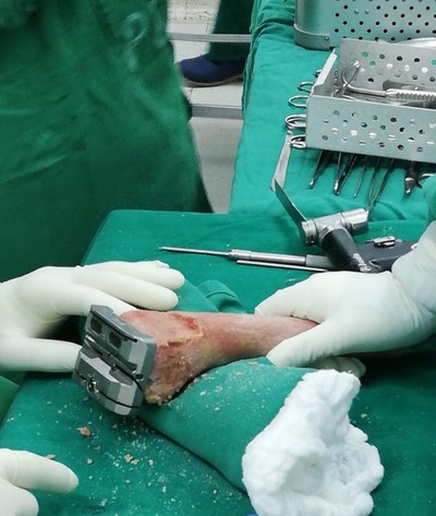 Clínicas: Realizan por primera vez aloprótesis de rodilla con hueso de banco de tejido nacional » San Lorenzo PY