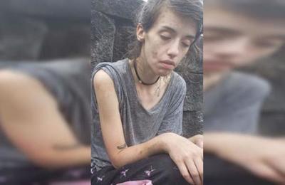 El impactante 'antes y después' de una joven adicta a las drogas - SNT