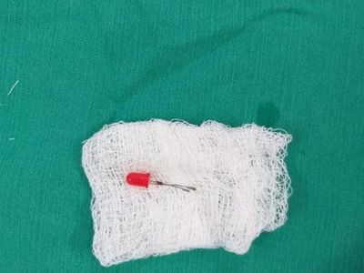 Médicos sacaron un "foquito" del pulmón de un nene de 2 años
