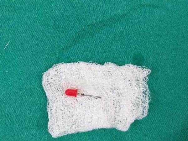 Médicos sacaron un "foquito" del pulmón de un nene de 2 años