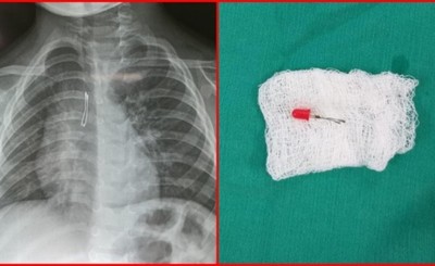 Extraen un foquito de uno de los pulmones de un niño de 2 años