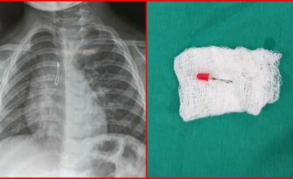 Extraen un foquito de uno de los pulmones de un niño de 2 años