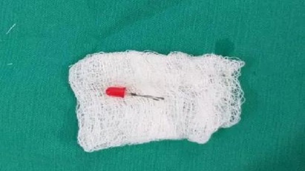 Médicos sacaron un "foquito" del pulmón de un nene de 2 años