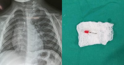 Niño de 2 años ingirió foquito de su juguete y debió ser llevado al quirófano