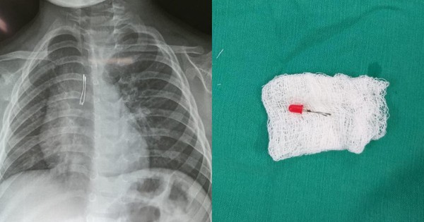Niño de 2 años ingirió foquito de su juguete y debió ser llevado al quirófano