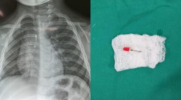 Niño de 2 años ingirió foquito de su juguete y debió ser llevado al quirófano