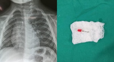 NIÑO DE 2 AÑOS INGIRIÓ FOQUITO DE SU JUGUETE Y DEBIÓ SER LLEVADO AL QUIRÓFANO