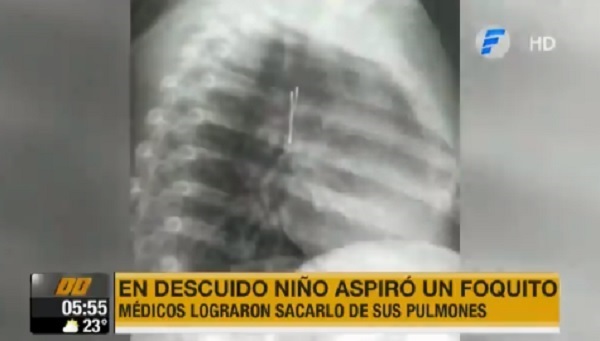 Extraen foco de juguete de pulmones de niño