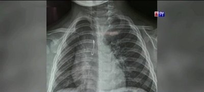 Niño de dos años aspiró un foquito | Noticias Paraguay