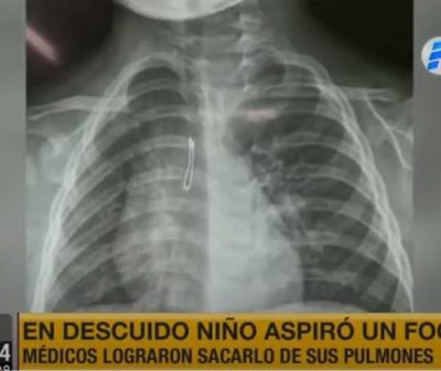 Niño de 2 años aspiró el foquito de un juguete y fue intervenido