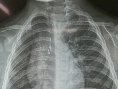 Médicos extraen un foquito del pulmón de un niño de 2 años