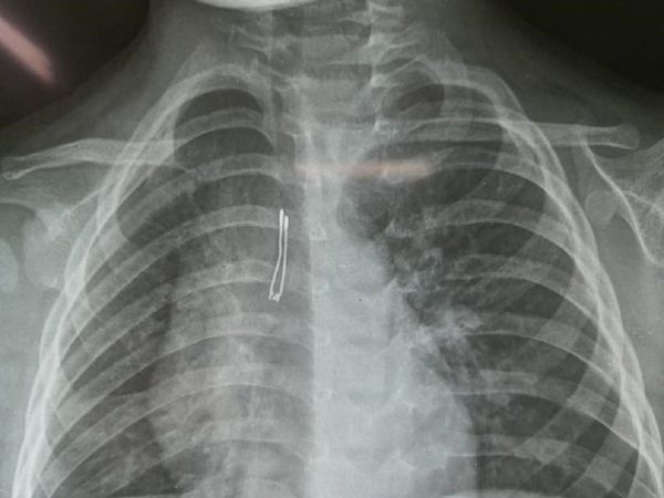 Médicos extraen un foquito del pulmón de un niño de 2 años