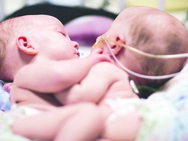 Papás de los bebés siameses aceptaron la operación