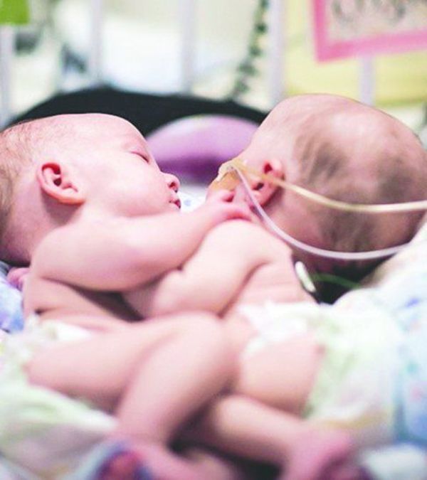 Papás de los bebés siameses aceptaron la operación - Digital Misiones
