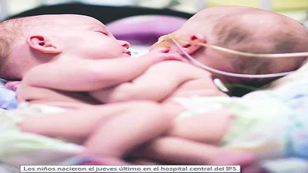 Papás de los bebés siameses aceptaron la operación