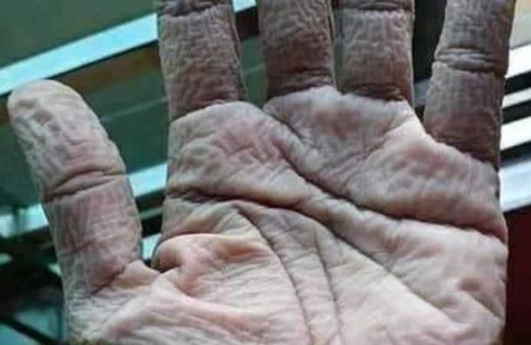 Así queda la mano de un médico al quitarse los guantes protectores tras 10 horas de trabajo - C9N