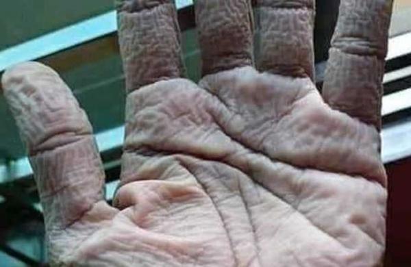Así queda la mano de un médico al quitarse los guantes protectores tras 10 horas de trabajo - SNT
