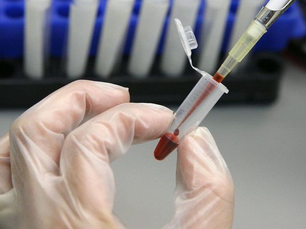 Remisión del virus del sida en un brasileño sin trasplante de médula