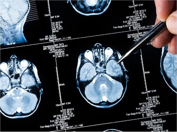 Plataforma agilizará la investigación en metástasis cerebral