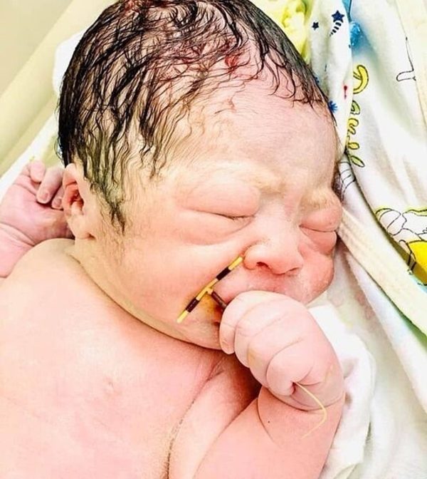 Bebé nació con el DIU de su mamá en la mano