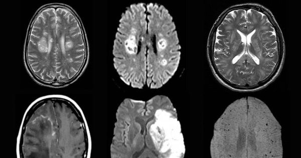 COVID-19 puede causar problemas cerebrales incluso en sus formas benignas