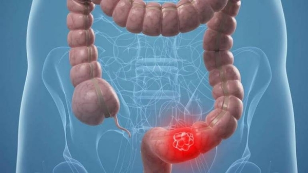 HOY / Cáncer de colon es prevenible a través una buena alimentación