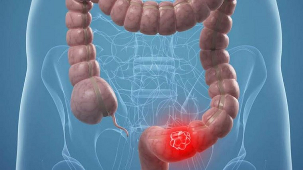 Cáncer de colon es prevenible a través de una buena alimentación