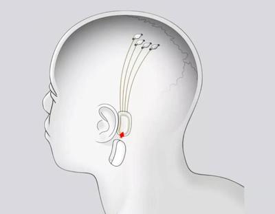Elon Musk trabaja en un chip que te permitirá transmitir música directamente a tu cerebro - El Trueno