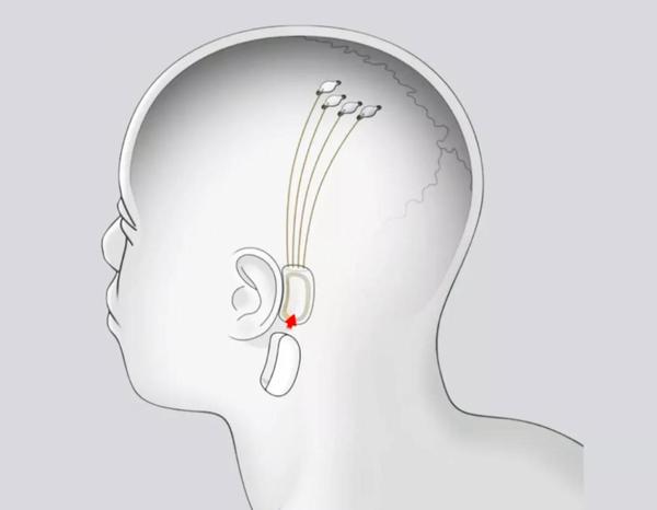 Elon Musk trabaja en un chip que te permitirá transmitir música directamente a tu cerebro - El Trueno