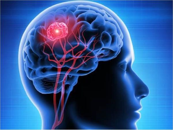 Descubren cómo algunos tumores cerebrales esquivan quimioterapia