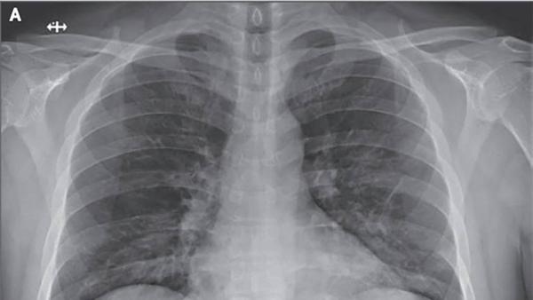 Covid-19 CDE; “Nos llegan pacientes con pulmones destrozados” – Prensa 5