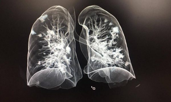 COVID-19 CDE: “Nos llegan pacientes con pulmones destrozados”