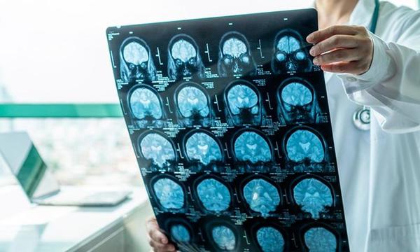 Ataques y derrames: los daños que causa el COVID-19 al cerebro – Prensa 5