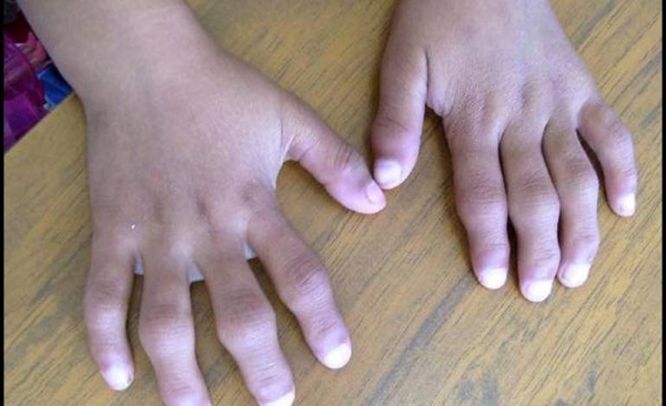 HOY / Artritis juvenil: importancia del diagnóstico temprano