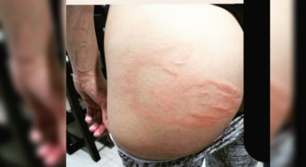 Un hombre golpeó a una yiyi en la nalga y dejó una feroz marca